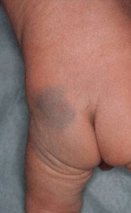 Mongolian birth mark