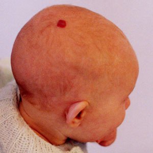 Birthmarks – Is This Permanent? | Bella Madre